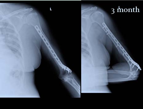 But both intra-articular and extra-articular distal humerus fractures should not be put in the same mold of treatment. Damage caused by excessive soft tissue stripping should not be overlooked. John T Capo et al. (1) did a retrospective study where in his study at final follow-up; mean flexion was of 126±16 °, and extension was 7±7°a t final follow-up. In Yatinder kharbanda et al. (12) study mean flexion was 125 °, and only one patient had flexion deformity of 5 °at the end of one year after surgery. Rajendraprasad bhutala et al. (13) at 6 months of the study showed flexion of 128 °, and full extension in 17 cases and +10 in other 3 cases, and had concluded as excellent functional outcomes. In 2013 Gregory M. Meloy (14) did a multi-centered retrospective comparative study: A paradigm shift in the surgical reconstruction of extra-articular distal humeral fractures: single-column plating. Group 1 consisted of 53 extraarticular distal humeral fractures treated with dual column plating. Group 2 comprised 51 patients who were managed with a single pre-contoured poster lateral locking plate. In Group 1 (dual plating), the mean elbow flexion achieved was 127.09 ± 14.968 °, and the mean elbow extension was -12.44 ± 10.848 °. In Group 2, the mean elbow flexion achieved was 136.1 ± 7.78 °, and the mean elbow extension was -3.62 ± 4.968 °, they concluded Group 2 (single plating) had a better overall range of motion than Group 1. Group 2 in this study was compared to our study where mean flexion is 141.67 ± 4.201 °, and mean extension is 1.11 ± 3.234°. Our discussion with other studies comes to a conclusion that reduced soft tissue stripping, elimination of olecranon impingement or need of olecranon osteotomy has resulted in faster recovery, reduced rehabilitation time in flexion extension movement at elbow joint and thus the patients returned to their day to day activities earlier (