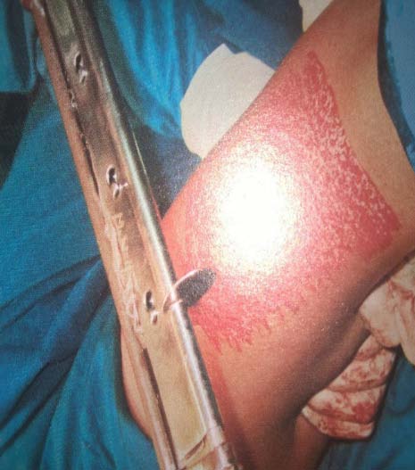 Figure 1: Age distribution of study population (n=82)