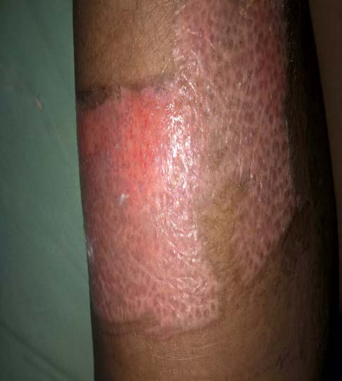 Figure 3: Distribution of symptoms in percentage d) Duration of symptomsThe duration of symptoms was as shown in the table below. These were divided into intervals of 3 days for simplicity of presentation due to wide range. 46 (56.09%) patients were seen within the first three days of symptoms. The duration of symptoms was not documented in 1 (1.21%) patients.