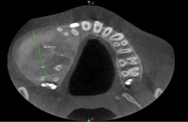 Figure 7: Grossing picture of the lesion after biopsy