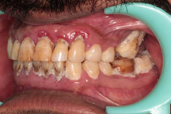 Fig. 1 a and b: Intra-oral view showing gingival recession with 27, missing 26