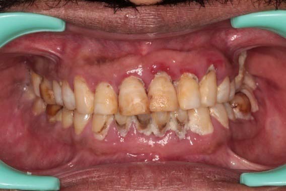 Fig. 2 a: Clinical photograph showing two implant placements (26, 28) in left maxillary region