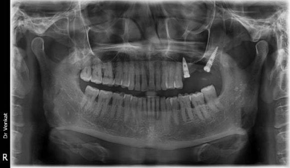 Fig. 3 a: Intra-oral view shows missing posterior maxillary teeth and badly decayed upper front teeth