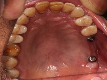 Fig. 5 c: Pre-operative OPG showing severe bone loss and inadequate bone in maxillary sinus region