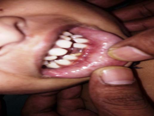 Figure 1: Ill formed lower incisor since birth.