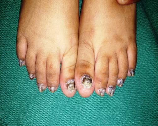 Figure 2 (a,b): Yellowish Brown discoloration of nails and thickening of all twenty nails.