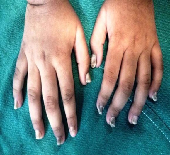 Figure 3: Small hyperkeratotic papules over both knees.