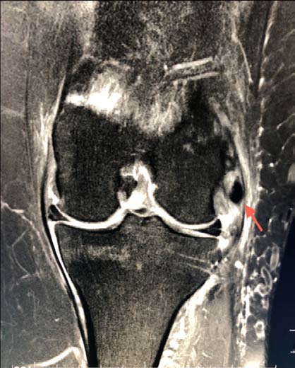 Fig.1aand 1b: X-ray AP and Lateral views showing calcific deposits over lateral condyle MRI scan showed intra-substance calcification in the LCL near the femoral attachment and associated medial meniscus root tear (Fig.2a, 2b). With no improvements with medications and conservative method of treatment for 1 year, the patient opted for our treatment plan of arthroscopic meniscal root repair with concomitant arthroscopic excision of LCL calcification.