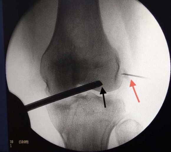 Figure 3: Lateral Epiconcdyle Needle Fig. 3: Needle (Red arrow) placed over Calcific deposits under IITV* guidance (*IITV-Image intensifier television)and arthroscope( Black arrow) viewing from the anterolateral portal and knee in Extension