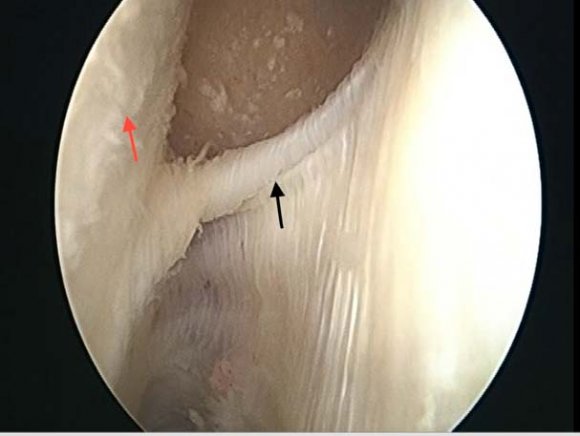 Figure 5: LCL and Popliteus Fig. 5: Direct lateral portal-(Red Arrow-Needle over lateral epicondyle and Black arrow-Direct Lateral Portal)