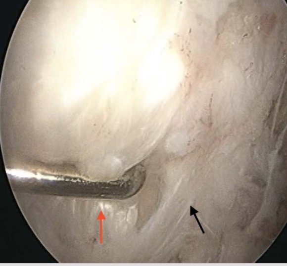 Fig. 8: Postoperative X-ray Knee AP and lateral views showing clearance of calcific deposits. We are the first in the literature to describe arthroscopic excision of calcific deposit in LCL by a new portal 'Direct lateral portal' or 'Bengaluru Chandrashekar portal' for the knee. With this new innovative technique in arthroscopy, the utilization of arthroscopy technique has been amplified. We have utilized it to debride the calcific deposits in the femoral side of LCL and Popliteus, to visualize isometric point of femoral side reconstruction of anterolateral ligament (ALL), and also for visualization and repair of femoral avulsion of LCL and Popliteus.