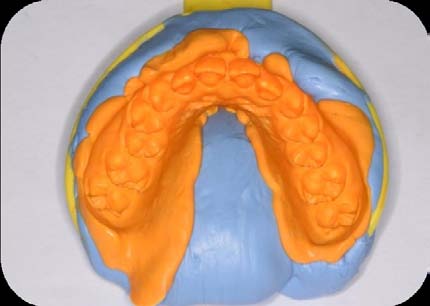 Figure 4: CBCT images showing the C-shaped canal configuration: (A) changes or (B) no changes. (A1 and B1), coronal third; (A2 and B2), middle third; (A3 and B3), apical third.