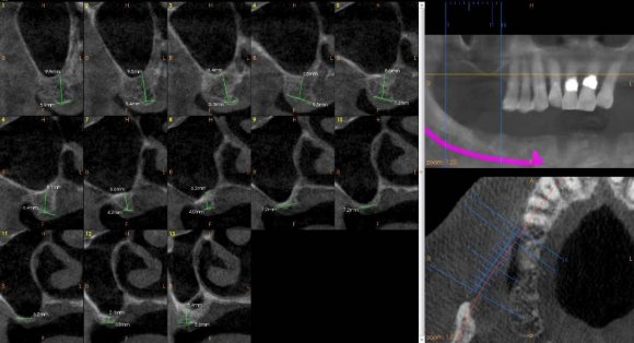 Figure 2: Shows the CBCT scan of maxilla preoperatively