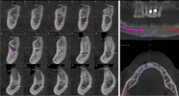 Figure 3: Shows the pre operative CBCT scan of mandibular arch with measurements