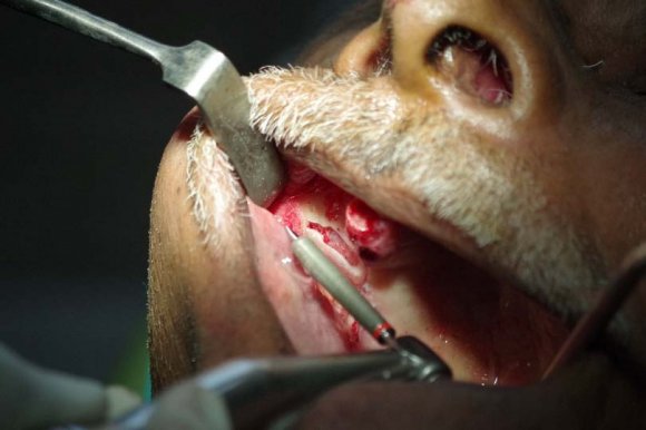Figure 4: Shows fine bur with lateral osteotomy of the right maxillary sinus.