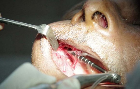 Figure 5: Shows osteotomy in the zygomatic complex with long zygomatic implant drill