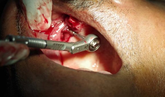 Figure 7: Shows bilateral zygomatic implants insitu.