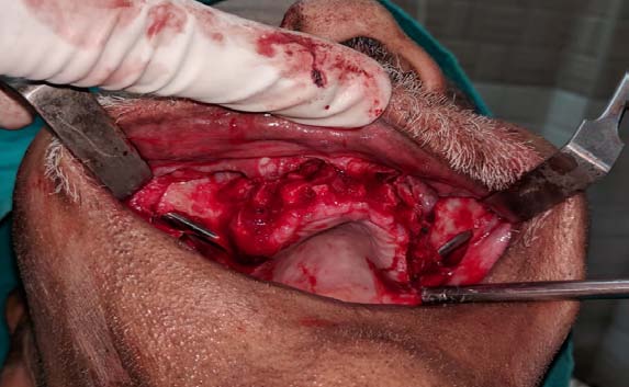 Figure 8: Shows the fully oseteointegrated zygomatic implants bilaterally.