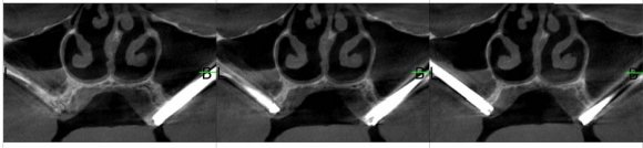 Figure 9: Shows the osteointegrated implants in the anterior maxillary region with excellent bone formation after nasal floor lift (red arrow)