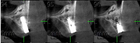 Figure11: Shows OPG with a total of 11 implants out of which 2 were big zygomatic implants ( right : dia 4.2 length 40 left: 42.5 length) and 3 were conventional implants in maxillary arch and rest of the 6 implants were placed in mandible in which 1 implant on the right posterior region was small (5dia 6 length) to avoid nerve impingement.