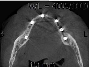 Figure 12: Shows intraoral picture with MUA (Multi Unit Abutment)