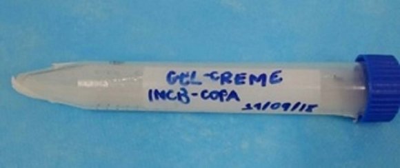 Figure 1: Pre OP Profile View On palpation, the swelling was diffuse, soft in consistency; mobile, not fixed to skin, non-tender on palpation, no localized rise in temperature, nonreducible, and compressible, non-pulsatile. Intra-oral examination revealed vestibular obliteration in the right upper region posteriorly.