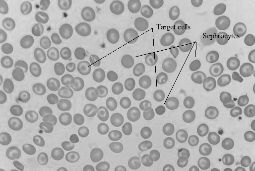 Fig. 1: Peripheral blood smear showing spherocytosis and Target cells.