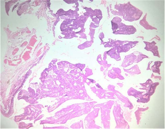 Fig. 1: A. Photomicrograph from the left papillary mass in the fornix (4x magnification) B. Photomicrograph showing dysplasia along with hemangioma (40x magnification) C. Clinical photograph of left eye after removal of papillary mass. III.