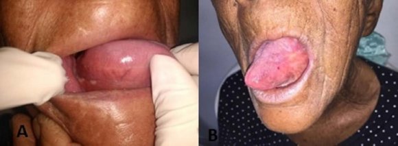 Figure 3 (A and B): Clinical aspect of the oral mucosa in the last week of radiotherapy treatment, showing recovered mucosa and absence of painful symptoms.