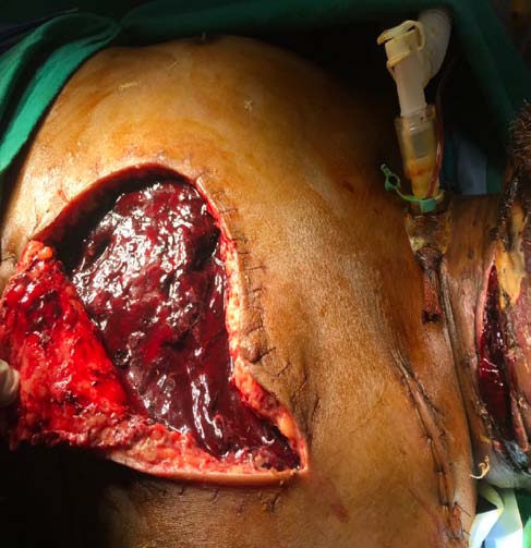 Figure 4 CECT of the face and neck was done and discussed with Interventional Radiologist who detected Pseudoaneurysm in the Left Internal Maxillary Artery.After multidisciplinary approach and discussion with the interventional radiologist, oncology team and plastic surgeon, patient was planned for embolization of the internal maxillary artery pseudoaneurysm. Consent was obtained for the same after discussing with the relatives about the procedure, the risks and the cost involved.Patient shifted into the operation theatre and prepared in routine surgical manner. Procedure done under local anaesthesia (LA) taking all the aseptic