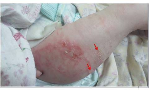 Milk Protein Allergy in Children with in herited Epidermolysis Bullosa