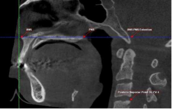 i. The patients included in the study were adults within the age group of 21 years to 30 years. ii. The patients should have a skeletal Class II jaw base with retrognathic mandible and an orthognathic maxilla. iii. Cephalometric criteria (mean pre-surgical values). SNB 76.40. ANB 4.70. Wit's Appraisal 2.4mm. iv. The patients should not have undergone any previous surgeries of the oral and maxillofacial region before the study.
