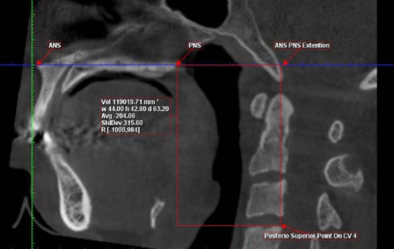 Figure 1: Sagittal section showing orientation to palatal plane with its landmarks (Pre-surgical) -ANS-Anterior nasal Spine -PNS-Posterior nasal Spine -C4up-The most superior point on the posterior border of the body of the C4