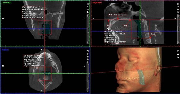 Figure 2: Demarcation of the total volume of interest required for the study (Pre-surgical) Depending on the density variations, the volume of the selected region is derived and displayed by the software in all the three orientation planes (Figure: 3). Thus, the air cavity was isolated and a 3D rendered image of the airway along with its volume (measured in mm 3 ) was displayed in the explorer window (Figure: 4a, 4b).