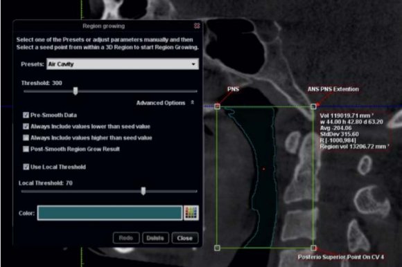 Figure 3: Airway isolated in coronal sagittal, axial and 3D rendered view