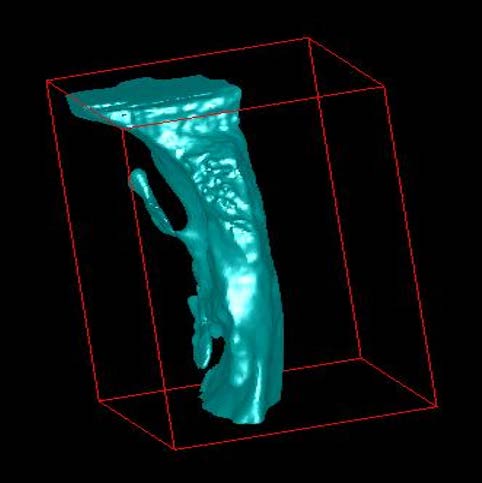 Figure 4(a): Measured Pharyngeal Airway Space volume (mm 3 )