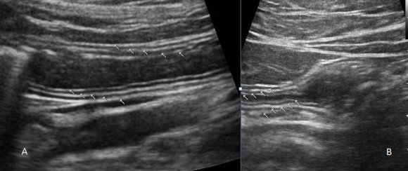 Observational and Comparative Study of Utility of Transabdominal Ultrasound in Diagnosis of Mild Acute Gastritis as followsespecially in Paediatric Age group and in Bed ridden