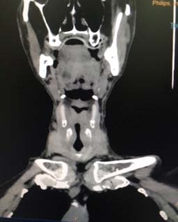 Figure 1: CT NECK coronal view showing supraglottic narrowing