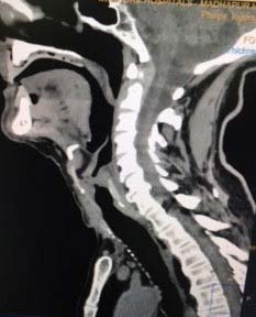 Figure 2: CT NECK sagittal view showing supraglottic narrowing