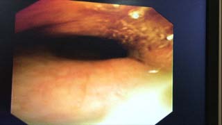 Figure 4: Bronchoscopy showing dynamic pharyngeal collapse II. Discussion Stridor in a post decannulated patient usually occurs due to tracheal stenosis, tracheomalacia, granulation tissue, nodules, polyps. The inicidence ranges from 20 to 67% in patients with long term tracheostomy tubes. But dynamic pharyngeal collapse may be an under recognized cause of stridor in post decannulated patient causing respiratory distress. Diagnosis is usually made by fiberoptic bronchoscopy. Treatment includes non invasive positive pressure ventilation.