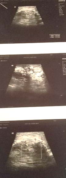 Fig. 1: Ultrasonography of the right breast showing an irregular breast image, BI-RADS 5.