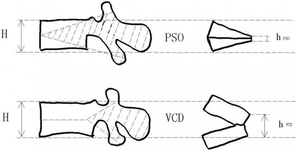 Figure 5: These two patients underwent VCD and PSO. The preoperative and postoperative heights of the posterior wall of the resected vertebras were measured (pre/postoperatively: VCD 17/14 mm, PSO 20/6 mm)