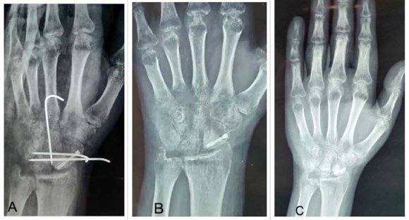 Figure 2: Shows X-rays (A) at 6 weeks and (B) upon K-wire removal depicting severe patchy osteopenia suggestive of complex regional pain syndrome (CRPS); (C) at 4 months with partial resolution of CRPS III.