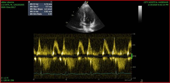 Figure 7: Normal mitral inflow pattern. E>A, E-early inflow wave: A-atrial contraction