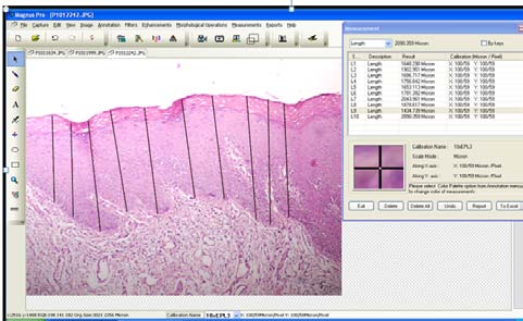 Fig. 1: Morphometric analysis of epithelial thickness (Magnus Pro Image analysis software, Olympus Inc.)