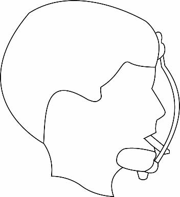Figure-1: Cyst associated with fusion of Maxilla; 1. Nasolabial or nasoalveolar. 2. Median alveolar. 3. Lateral alveolar. 4. Nasopalatine. 5. Median palatine