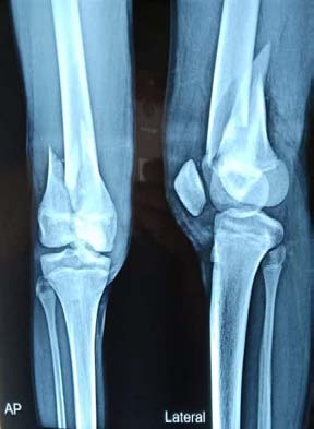 Fig. 1: Preoperative X-ray of the patient