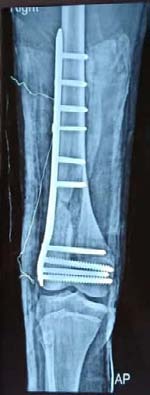 Fig. 3: Final follow up x-ray of the same patient