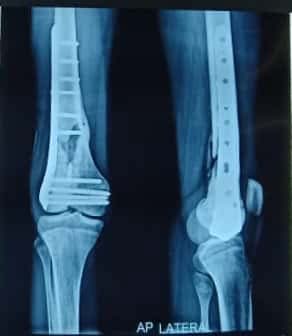 Proximal humerus locking plate found to have an optimum amount of profile thickness Year 2020