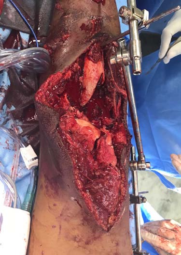Fracture grade and type. 2) Compartment syndrome. 3) Possibility of immediate fixation. 4) Duration and severity of ischaemia. 5) Loss of soft tissues of the foot. b) Patient related 1) Associated systemic injuries. 2) Shock. 3) Coaugulopathy. 4) Need for vasoconstrictiction. 5) ARDS. 6) Age. 7) Co-morbid conditions. 8) Hospital resources. 9) Transport time. 10) Mass/millitary casualty. 11) Patient Co-operation. c) Scoring systems d) Expected outcome Mandatory weight bearing? Protective sensations? Presence of durable skin and soft tissues.? e) Experience of Surgeon Availability of vascular and plastic surgeons. All above factors have to be considered individually and collectively to decide on amputation Vs salvage.